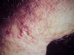 Dermatitis de Contacto | Patologias Dermatologicas